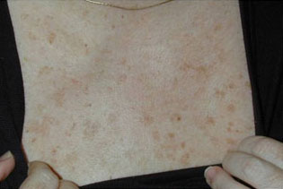 Laser to Remove Brown Spots