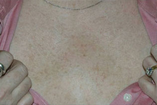 Laser to Remove Brown Spots