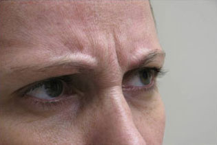 Botox, Daxxify, Dysport