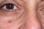 Laser to Remove Brown Spots