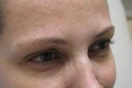 Botox, Daxxify, Dysport