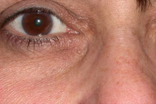 Laser to Remove Brown Spots