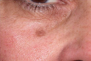 Laser to Remove Brown Spots