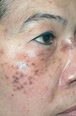 Laser to Remove Brown Spots