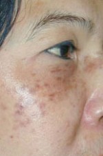 Laser to Remove Brown Spots