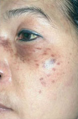 Laser to Remove Brown Spots