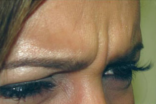 Botox, Daxxify, Dysport