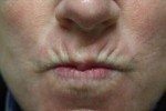 Botox, Daxxify, Dysport