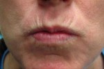 Botox, Daxxify, Dysport