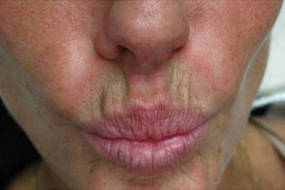 Botox, Daxxify, Dysport
