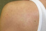 Vascular Laser