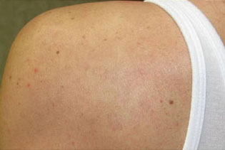 Vbeam® Vascular Laser Before & Afters in Rhode Island Vbeam® Vascular Laser Before & Afters in Rhode Island