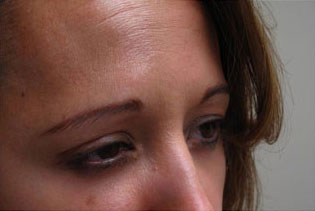 Botox, Daxxify, Dysport