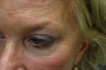 Botox, Daxxify, Dysport