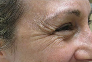 Botox, Daxxify, Dysport