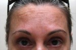 Botox, Daxxify, Dysport
