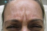 Botox, Daxxify, Dysport
