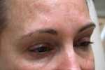 Botox, Daxxify, Dysport