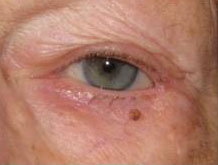 Skin Cancer Reconstruction