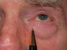 Skin Cancer Reconstruction