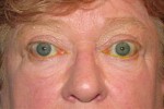 Thyroid Eye Disease & Graves' Disease