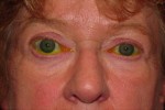 Thyroid Eye Disease & Graves' Disease