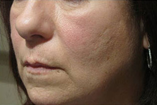 Skin Laser Resurfacing