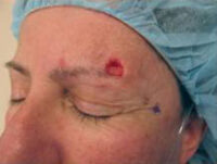 Skin Cancer Reconstruction