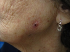 Skin Cancer Reconstruction