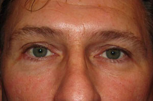 Fillers