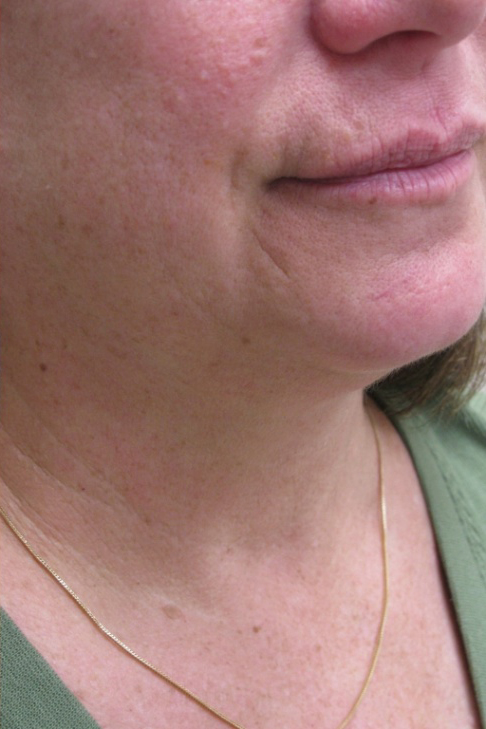 Neck Liposuction