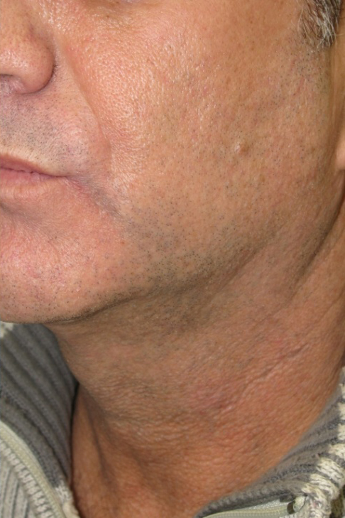 Neck Liposuction