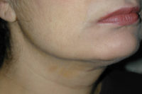 Neck Liposuction