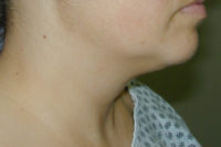 Neck Liposuction