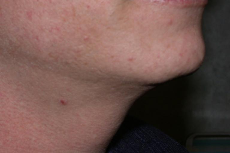 Neck Liposuction