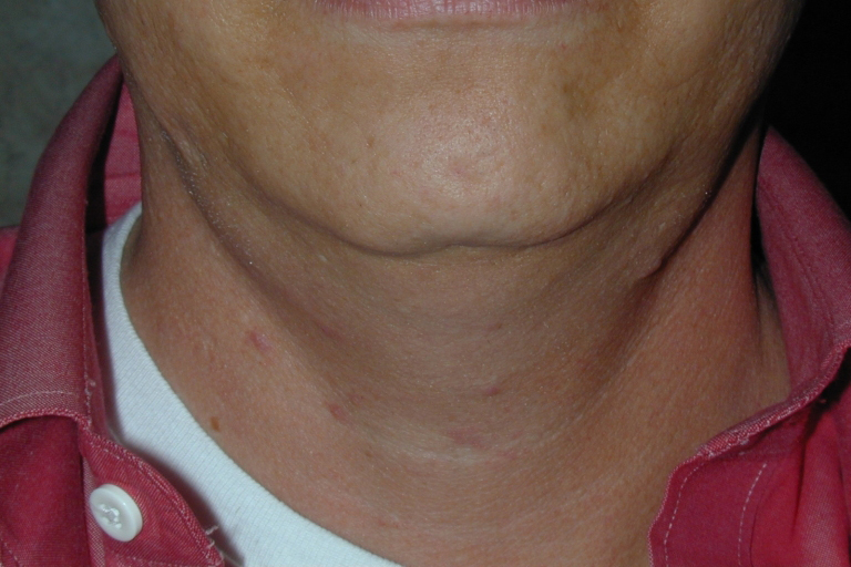 Neck Liposuction