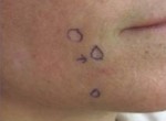 FaSula Scar Surgery