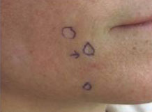 FaSula Scar Surgery