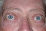 Thyroid Eye Disease & Graves' Disease