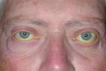 Thyroid Eye Disease & Graves' Disease