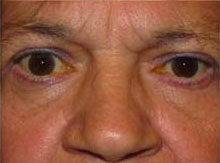 Thyroid Eye Disease & Graves' Disease