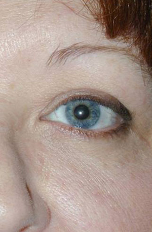 Thyroid Eye Disease & Graves' Disease