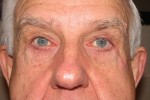 Eyelid and Upper Facial Surgery