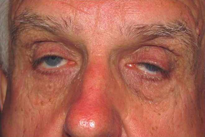 Eyelid and Upper Facial Surgery