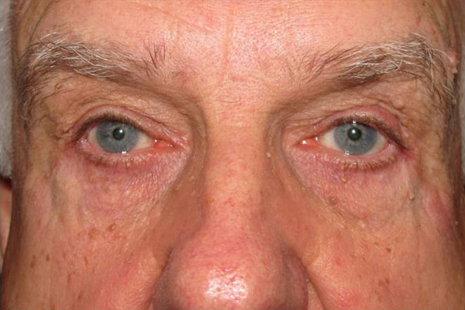 Eyelid and Upper Facial Surgery