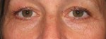 Eyelid and Upper Facial Surgery