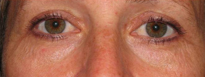 Eyelid and Upper Facial Surgery