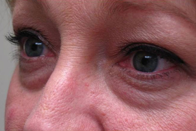 Eyelid and Upper Facial Surgery