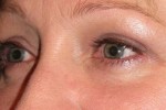 Eyelid and Upper Facial Surgery