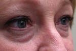 Eyelid and Upper Facial Surgery